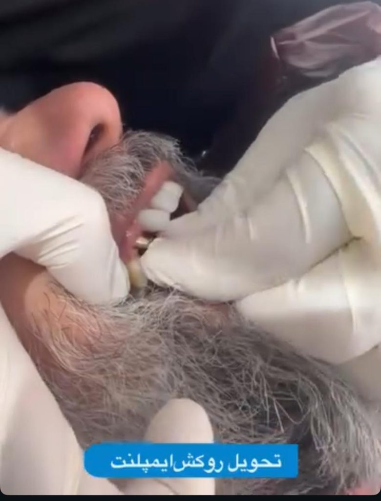 تحویل روکش ایمپلنت