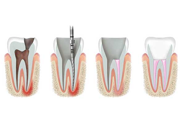 عصب کشی دندان چیست؟