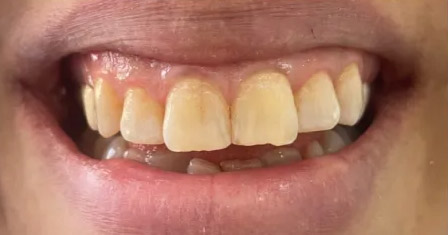 بلیچینگ دندان 2 بلیچینگ دندان