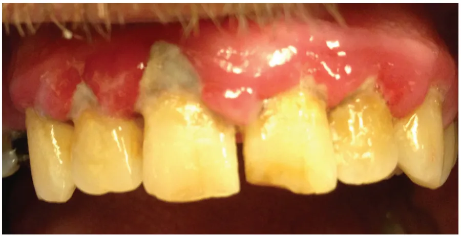 عوارض بلیچینگ دندان 1 تحریک و سوختگی لثه