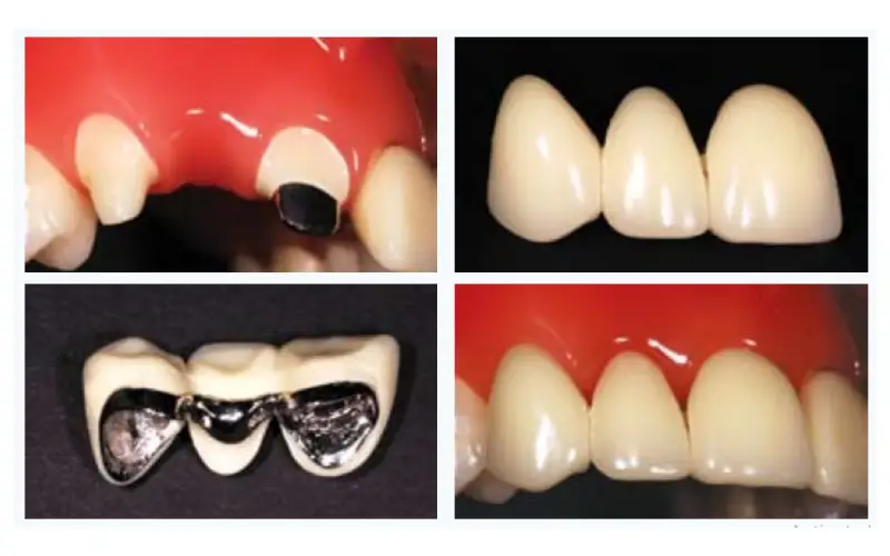 عوارض ایمپلنت نکردن دندان 6 بههمریختگی اکلوژن (بایت) و درد فک