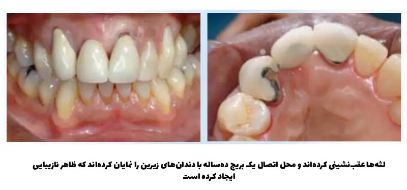 عوارض ایمپلنت نکردن دندان 1 10 عوارض ایمپلنت نکردن دندان