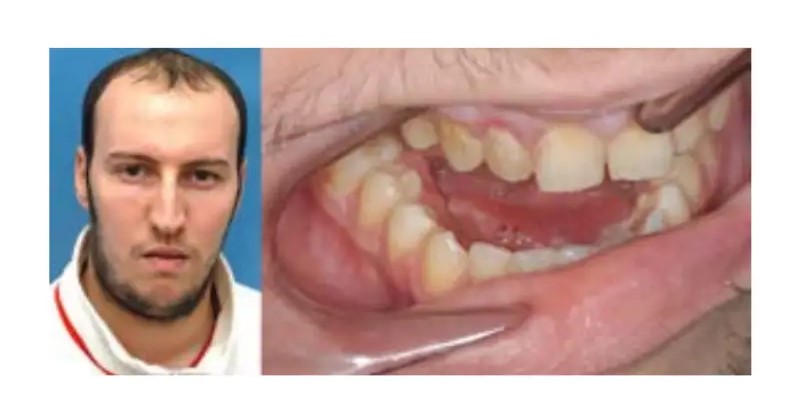 عوارض ایمپلنت نکردن دندان 5 افزایش پوسیدگی و عفونت دندانهای مجاور