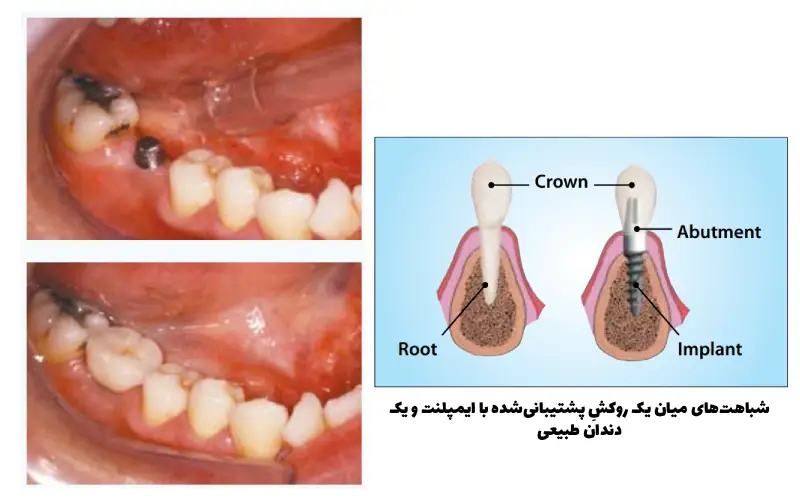 عوارض ایمپلنت نکردن دندان 3 دور شدن از حس داشتن دندان طبیعی