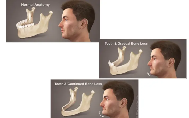 عوارض ایمپلنت نکردن دندان 4 کاهش تراکم و تحلیل شدید استخوان فک