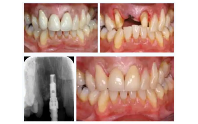 عوارض ایمپلنت نکردن دندان 2 کاهش اعتمادبهنفس و اختلال در عملکرد دهان