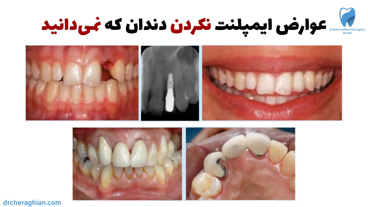عوارض ایمپلنت نکردن دندان - 10 مشکل جدی که باید بدانید!