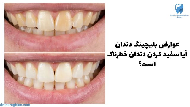 9 عوارض بلیچینگ دندان - سفید کردن دندان خطرناکه؟