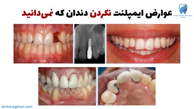 عوارض ایمپلنت نکردن دندان - 10 مشکل جدی که باید بدانید!