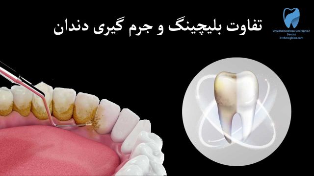 تفاوت بلیچینگ و جرم گیری + مقایسه 2 روش سفید کردن دندان