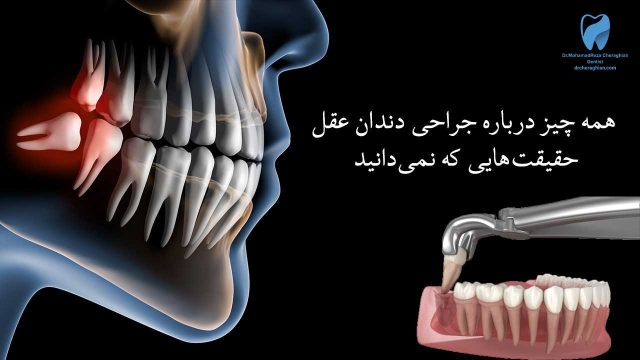 جراحی دندان عقل بدون درد