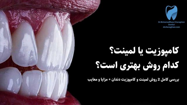 لمینت یا کامپوزیت؟ بررسی 5 تفاوت کامپوزیت و لمینت دندان