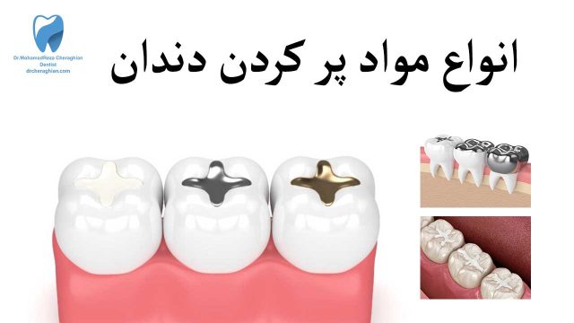 انواع مواد پر کردن دندان - بهترین، گرانترین و ارزانترین مواد
